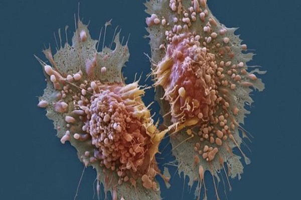 الفحص الجديد بالرنين المغناطيسي يراقب مدى سرعة خلايا السرطان في تفتيت جزيء البيروفات، وهذا يمنح الأطباء فكرة عن مدى نشاط هذه الخلايا