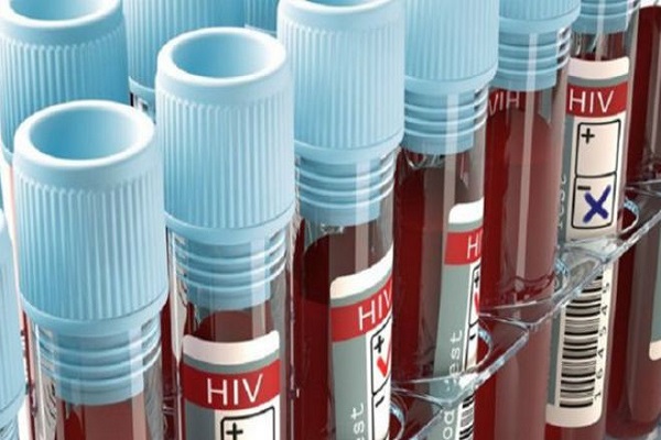 نقص الاختبارات قد يؤثر سلبا على مكافحة الايدز 