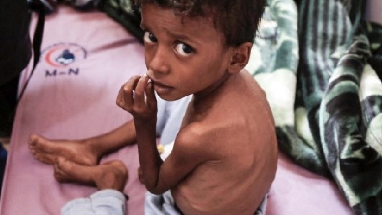 طفل يعاني سوء التغذية في اليمن، وهو أحد البلدان التي قالت منظمة أوكسفام إن فيها أزمة غذاء تفاقمت بسبب جائحة كوفيد-19