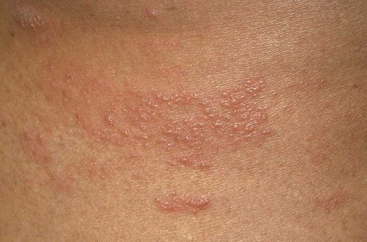 الطفح الجلدي أحد أعراض 