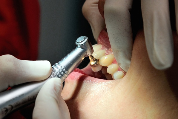 أدوات الأسنان قد تصيب بالزهايمر 