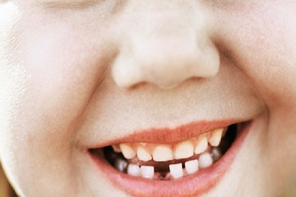 الاحتفاظ بأسنان الأطفال اللبنية للاستفادة من خلاياها الجذعية