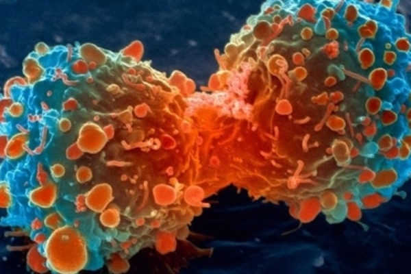 خلايا سرطانية
